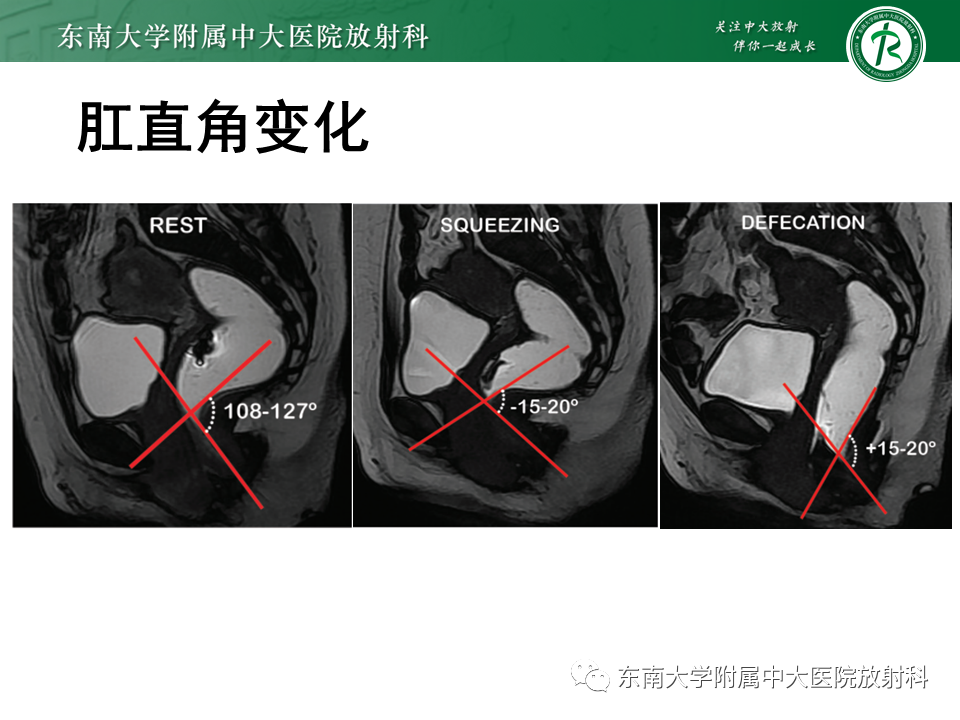 影像PPT - 【PPT】盆腔脏器脱垂—MR影像-15