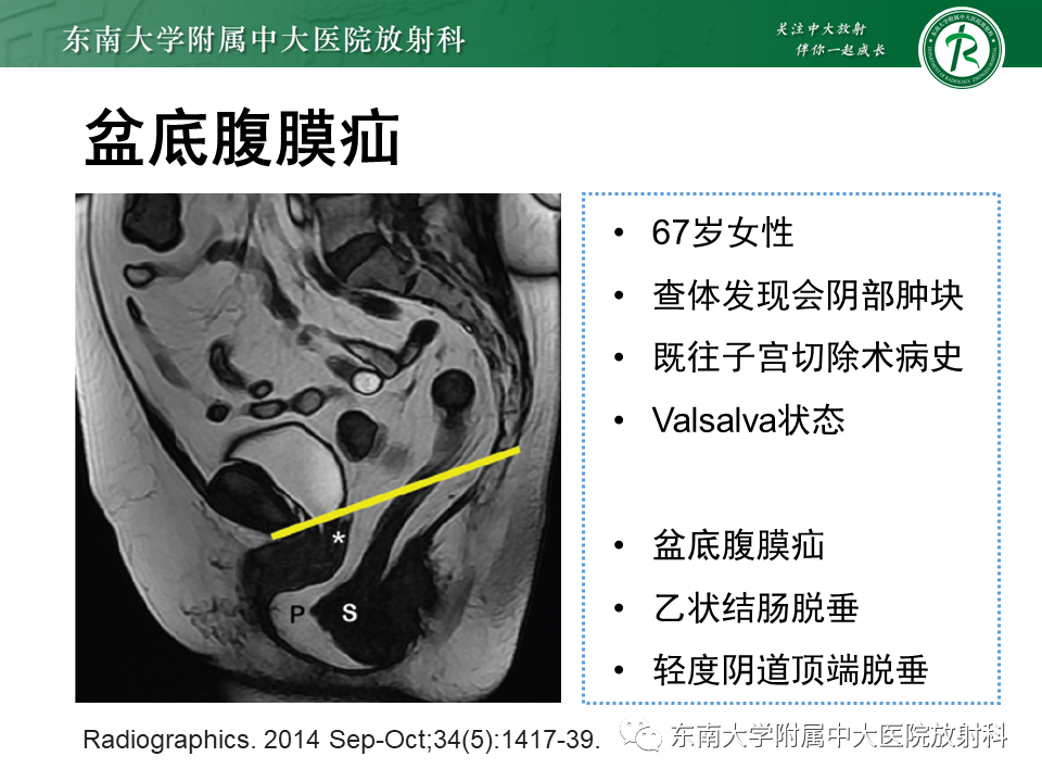 影像PPT - 【PPT】盆腔脏器脱垂—MR影像-19