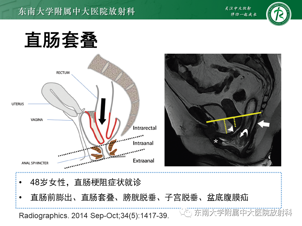 影像PPT - 【PPT】盆腔脏器脱垂—MR影像-20