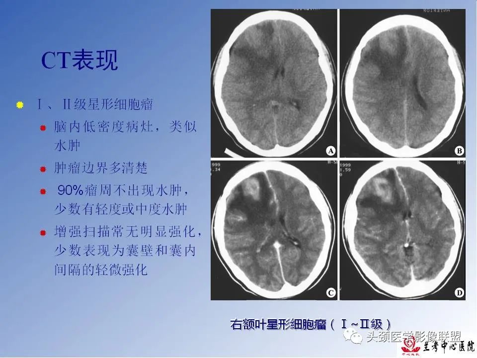 影像PPT - 【PPT】颅脑常见肿瘤影像诊断及鉴别-19