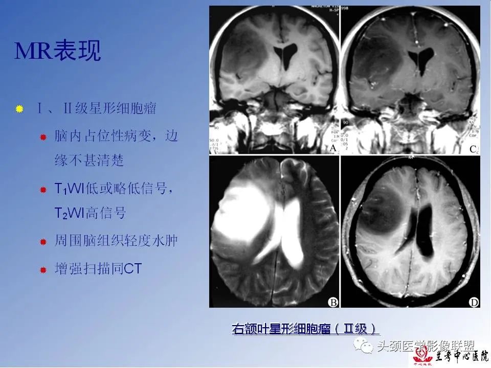 影像PPT - 【PPT】颅脑常见肿瘤影像诊断及鉴别-20