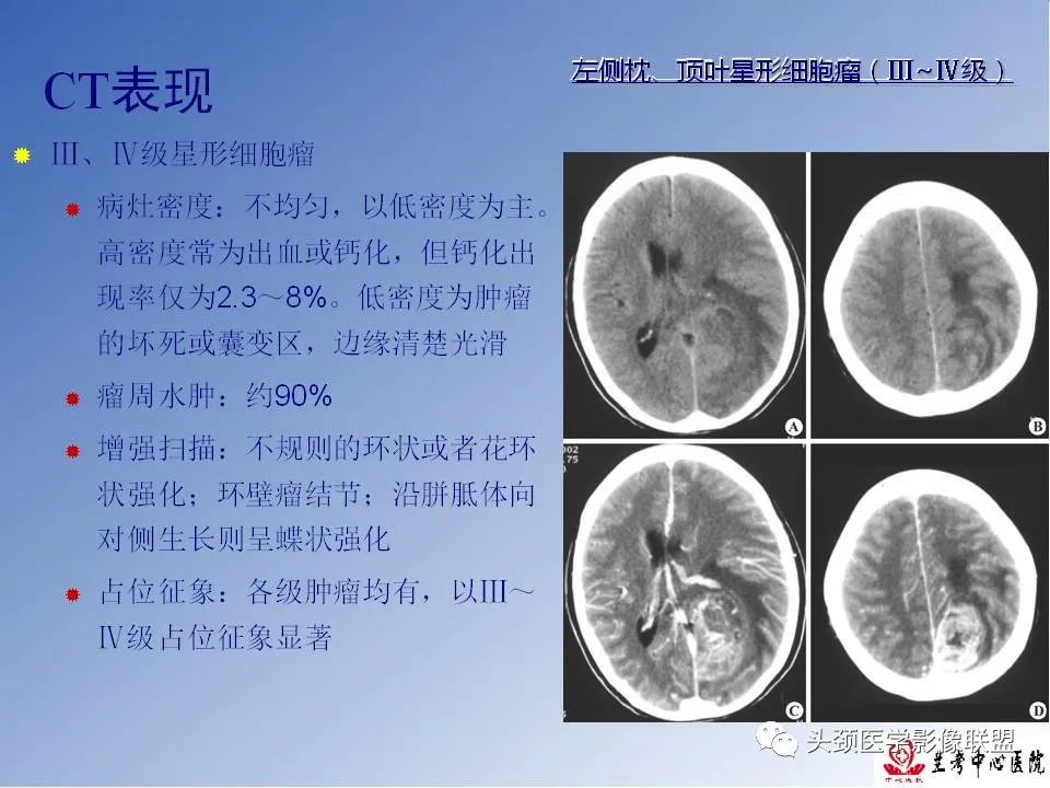 影像PPT - 【PPT】颅脑常见肿瘤影像诊断及鉴别-21
