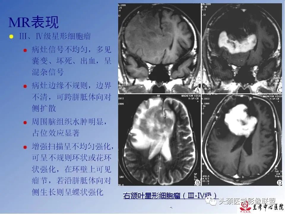影像PPT - 【PPT】颅脑常见肿瘤影像诊断及鉴别-22