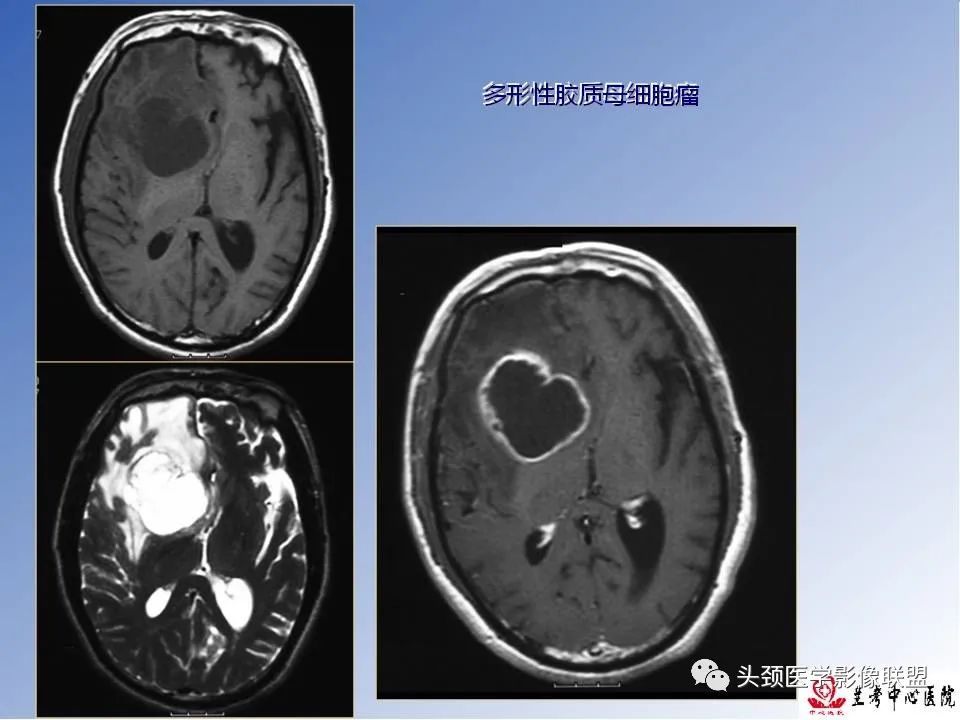 影像PPT - 【PPT】颅脑常见肿瘤影像诊断及鉴别-25
