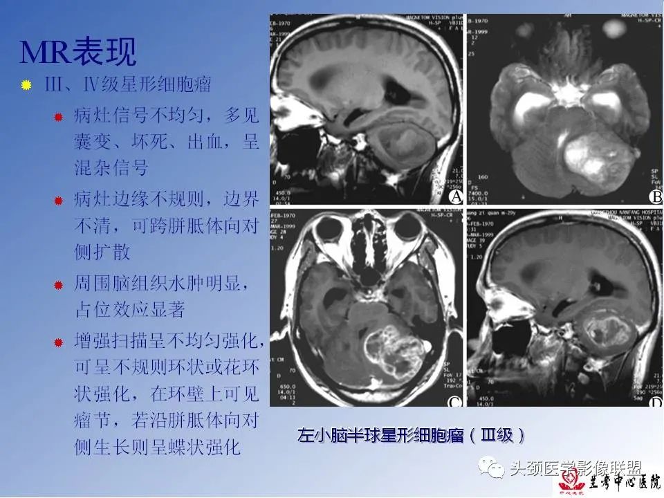 影像PPT - 【PPT】颅脑常见肿瘤影像诊断及鉴别-23