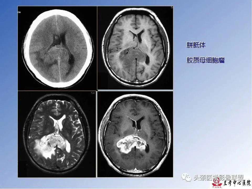 影像PPT - 【PPT】颅脑常见肿瘤影像诊断及鉴别-24