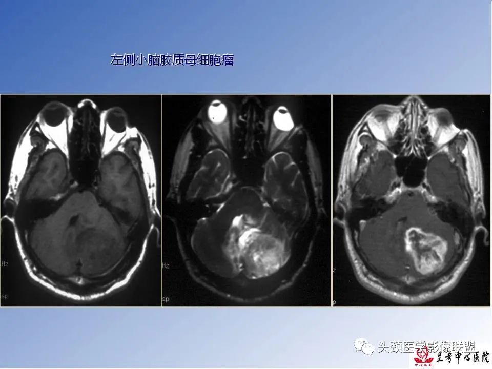 影像PPT - 【PPT】颅脑常见肿瘤影像诊断及鉴别-26