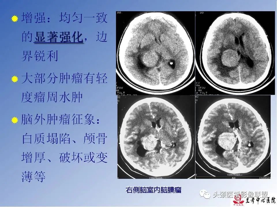 影像PPT - 【PPT】颅脑常见肿瘤影像诊断及鉴别-33