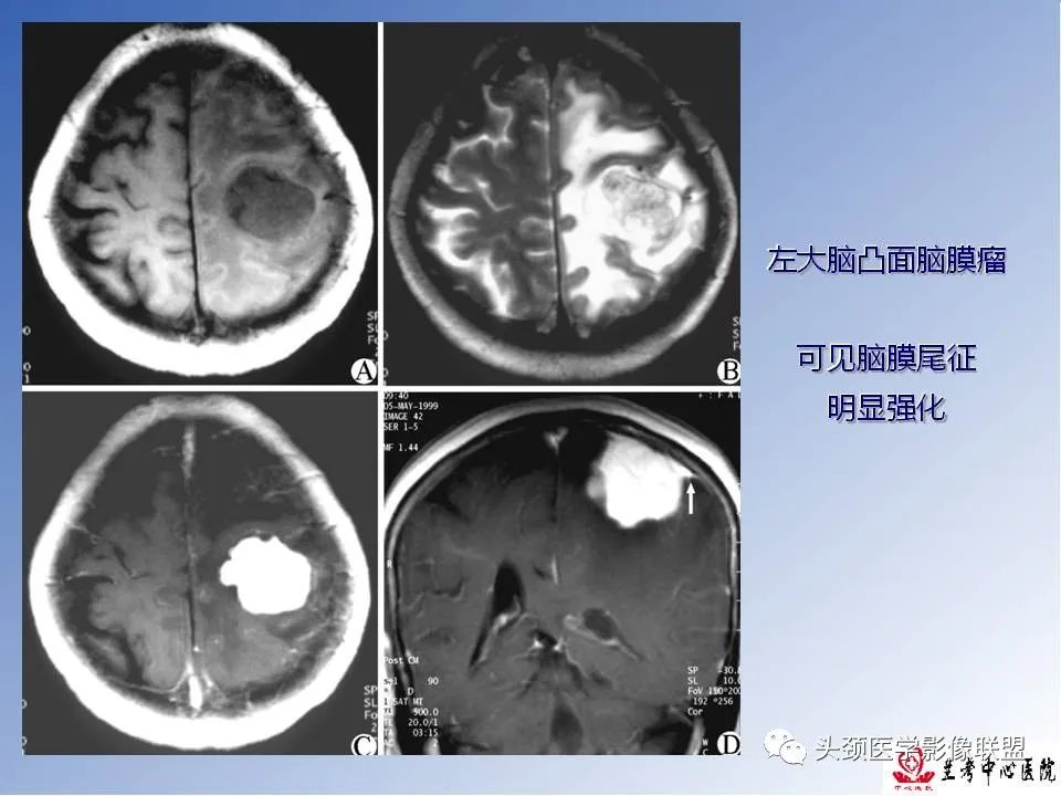 影像PPT - 【PPT】颅脑常见肿瘤影像诊断及鉴别-39