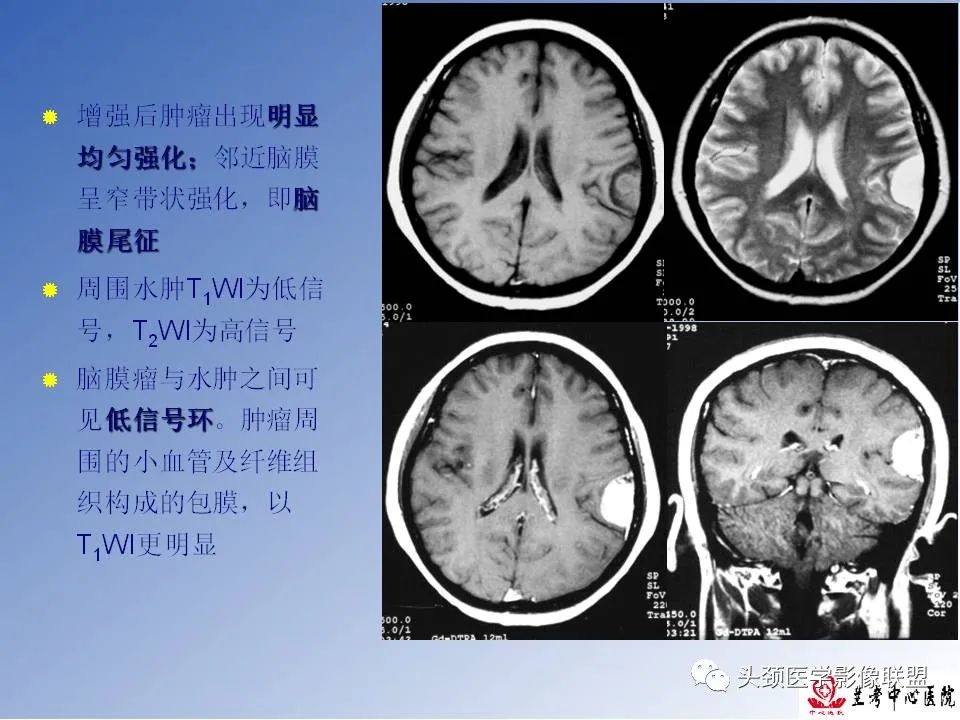 影像PPT - 【PPT】颅脑常见肿瘤影像诊断及鉴别-37
