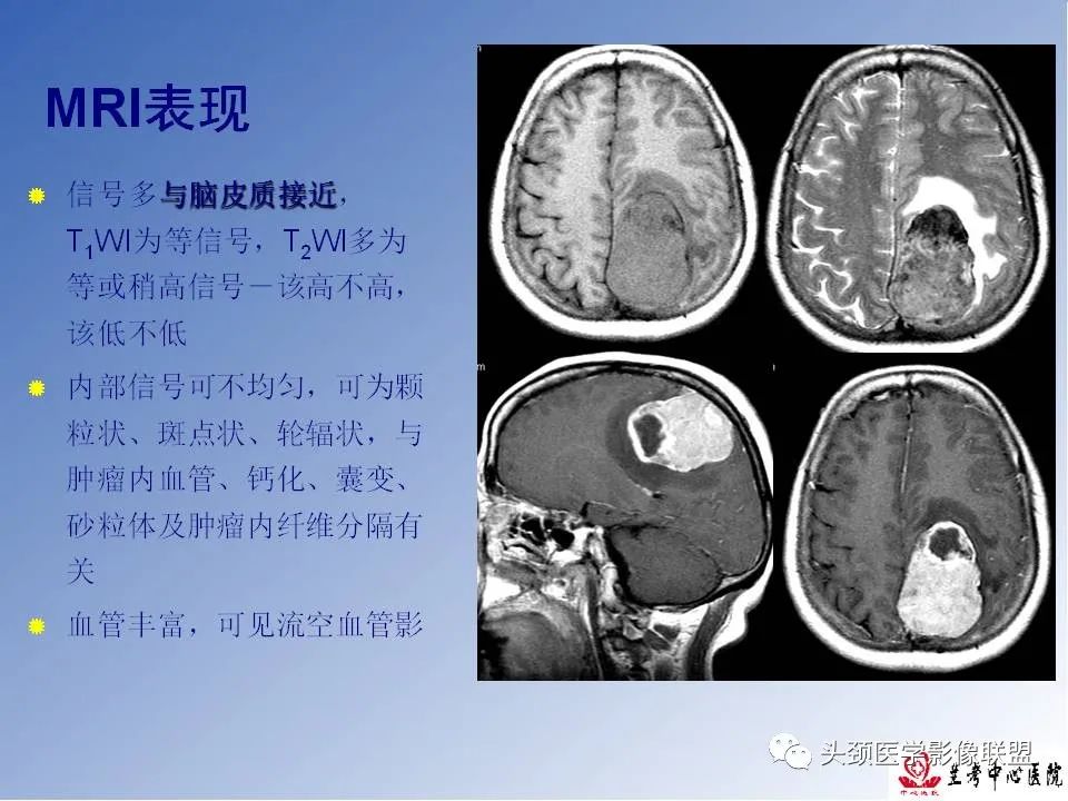 影像PPT - 【PPT】颅脑常见肿瘤影像诊断及鉴别-36