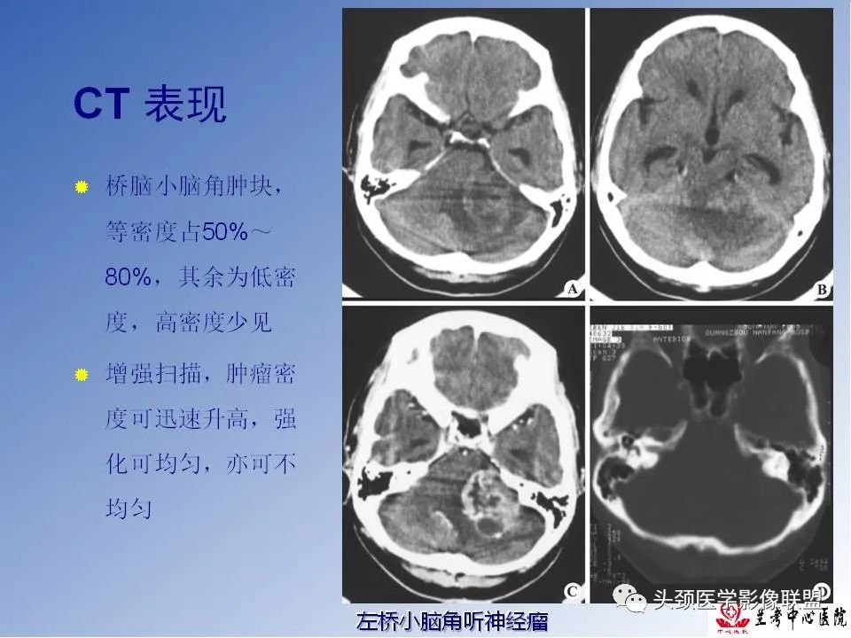 影像PPT - 【PPT】颅脑常见肿瘤影像诊断及鉴别-47