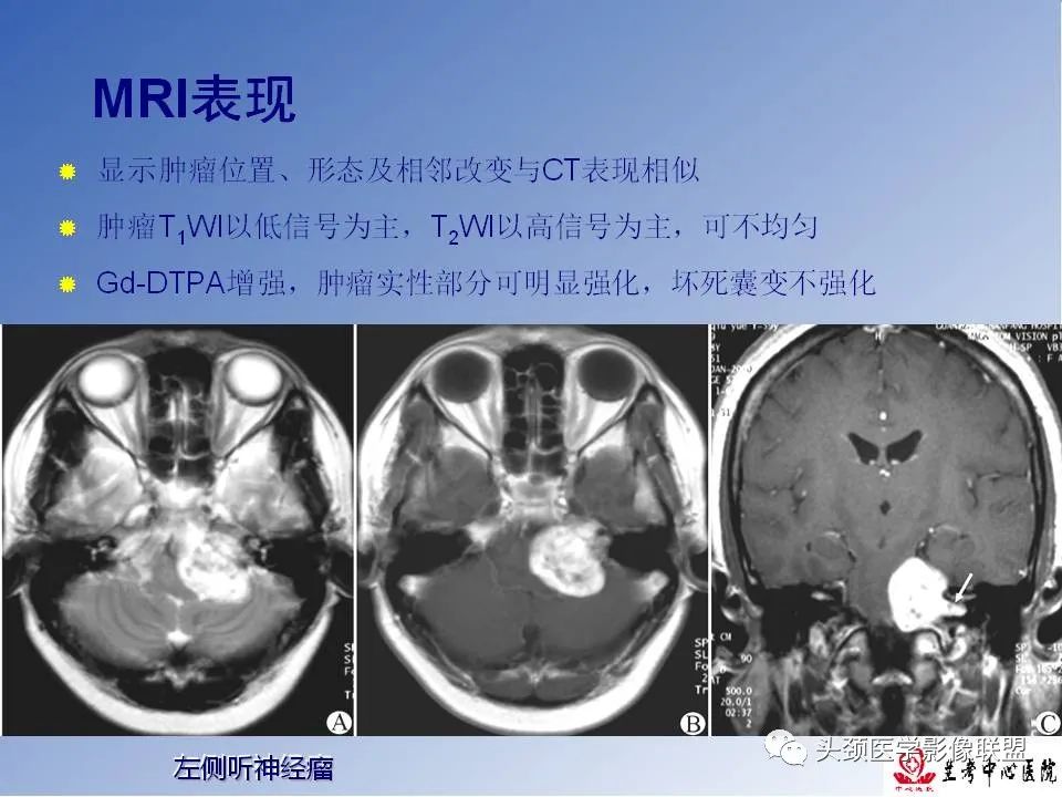 影像PPT - 【PPT】颅脑常见肿瘤影像诊断及鉴别-48