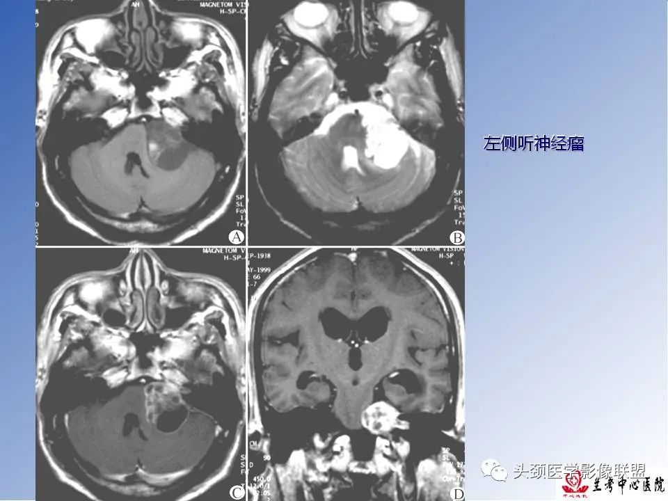 影像PPT - 【PPT】颅脑常见肿瘤影像诊断及鉴别-49