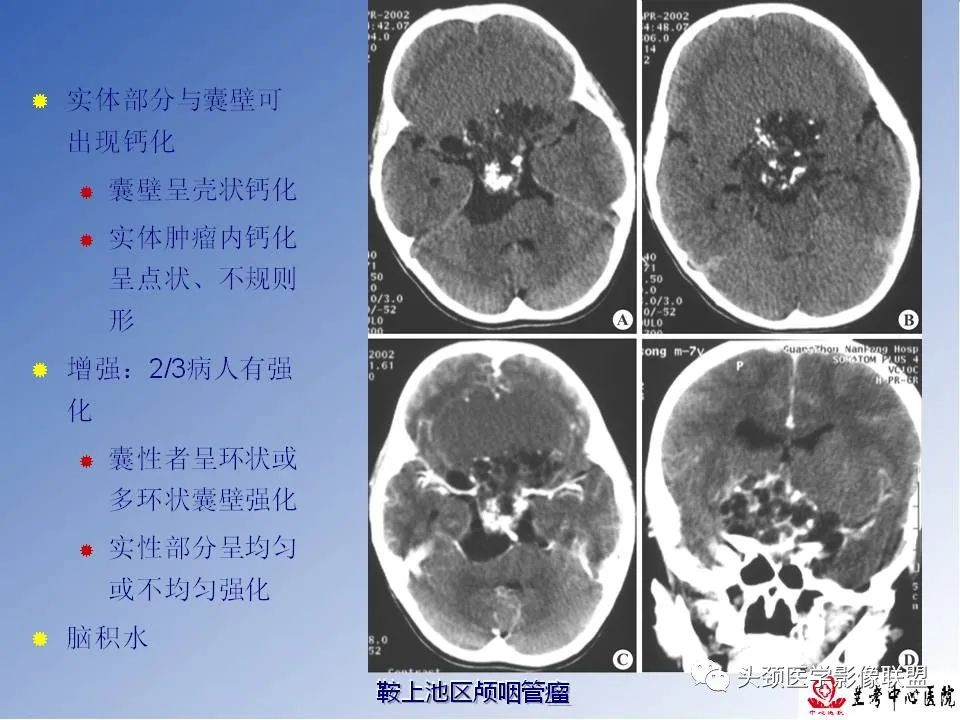 影像PPT - 【PPT】颅脑常见肿瘤影像诊断及鉴别-56