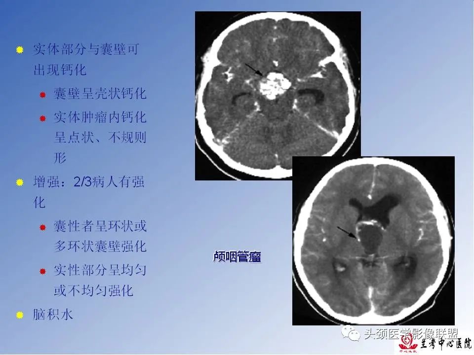 影像PPT - 【PPT】颅脑常见肿瘤影像诊断及鉴别-57