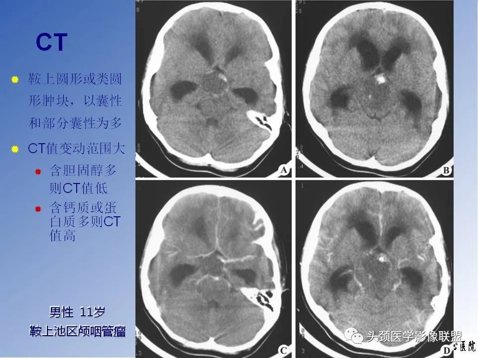 影像PPT - 【PPT】颅脑常见肿瘤影像诊断及鉴别-55