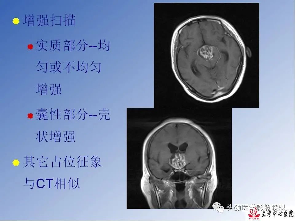 影像PPT - 【PPT】颅脑常见肿瘤影像诊断及鉴别-60