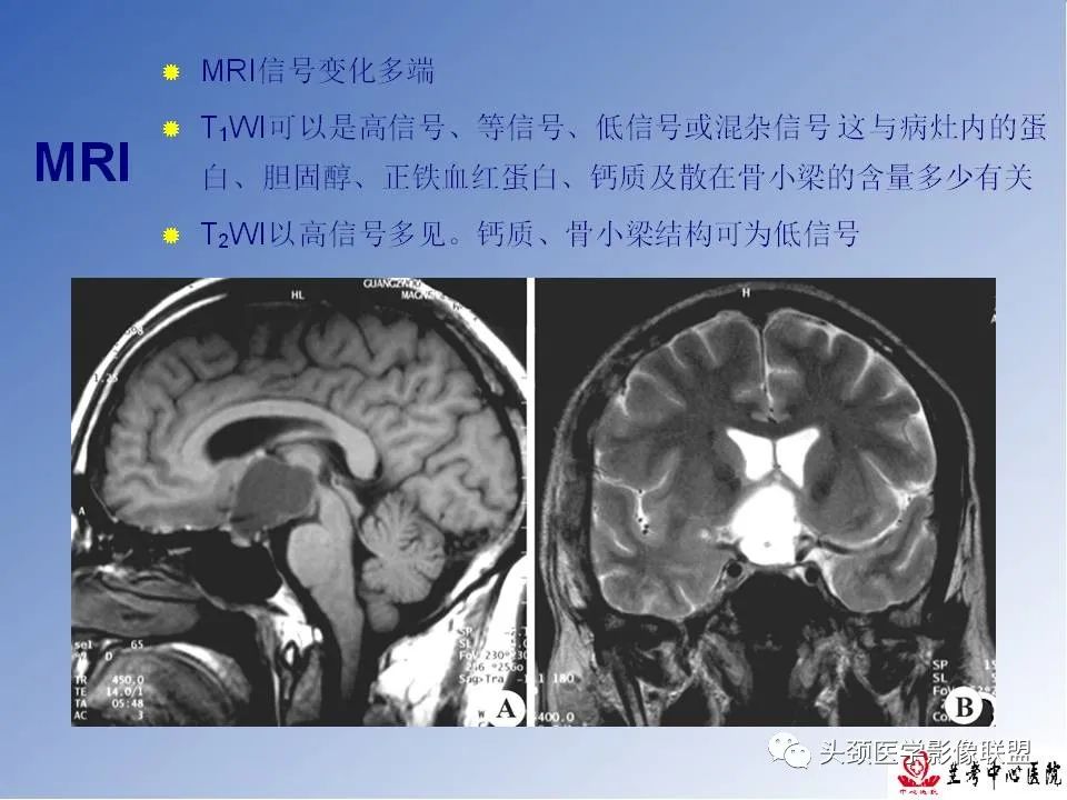 影像PPT - 【PPT】颅脑常见肿瘤影像诊断及鉴别-58