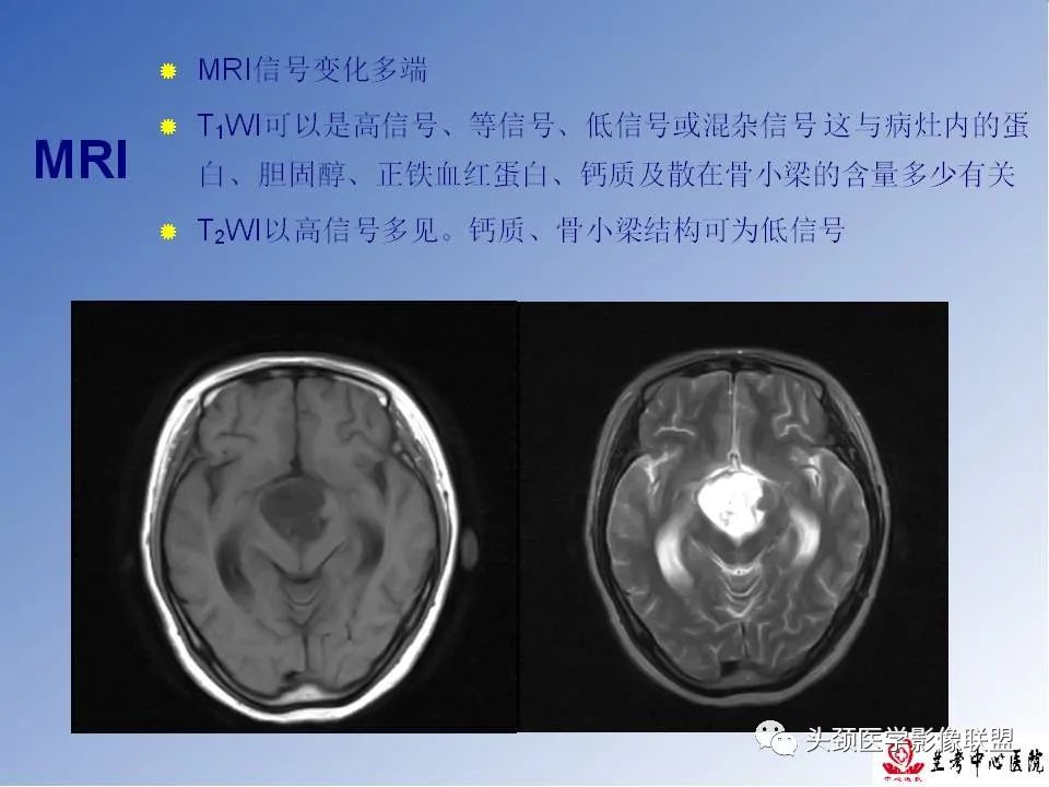 影像PPT - 【PPT】颅脑常见肿瘤影像诊断及鉴别-59