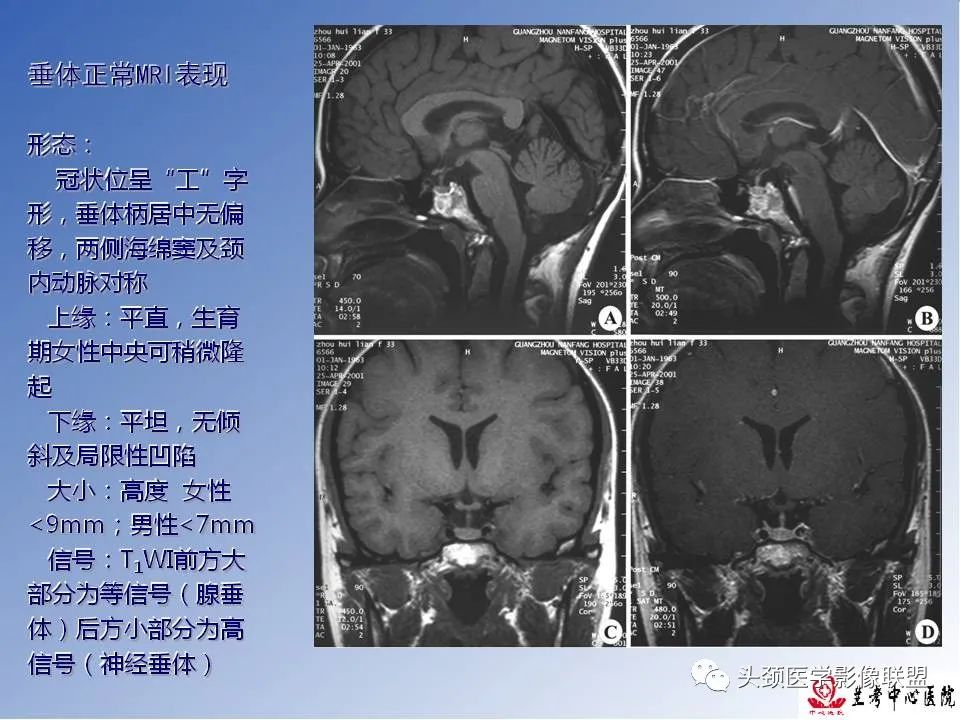 影像PPT - 【PPT】颅脑常见肿瘤影像诊断及鉴别-64