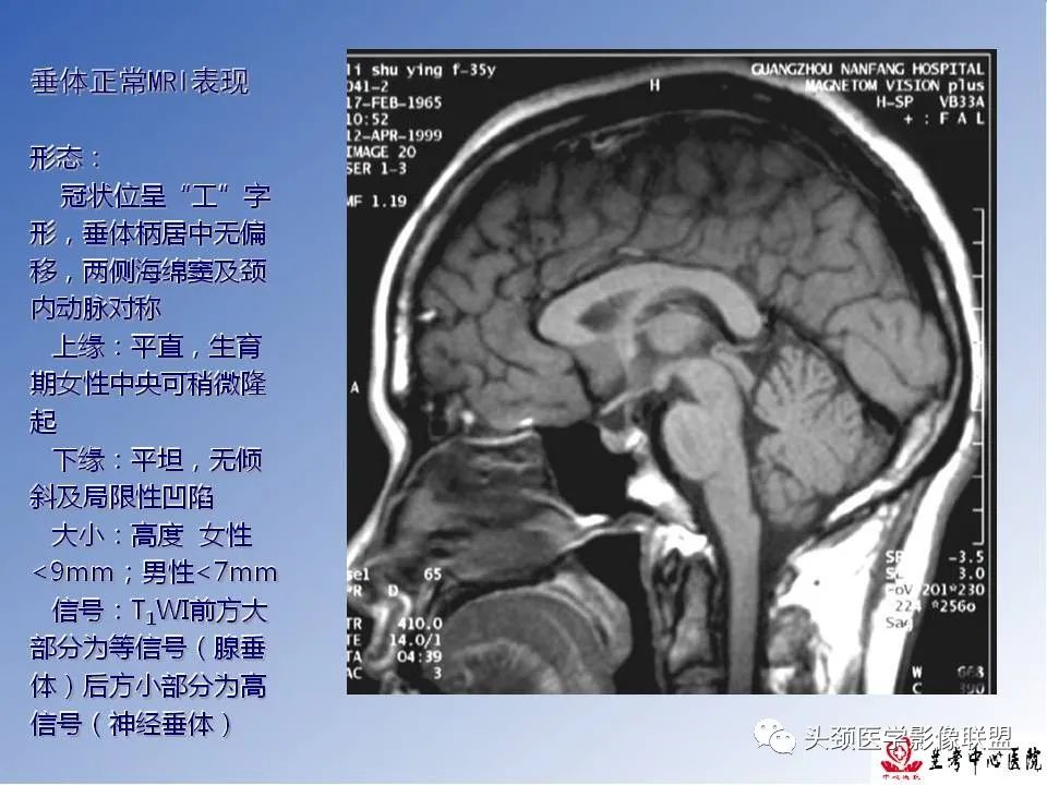 影像PPT - 【PPT】颅脑常见肿瘤影像诊断及鉴别-65