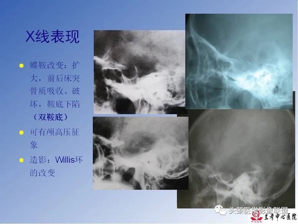 影像PPT - 【PPT】颅脑常见肿瘤影像诊断及鉴别-66