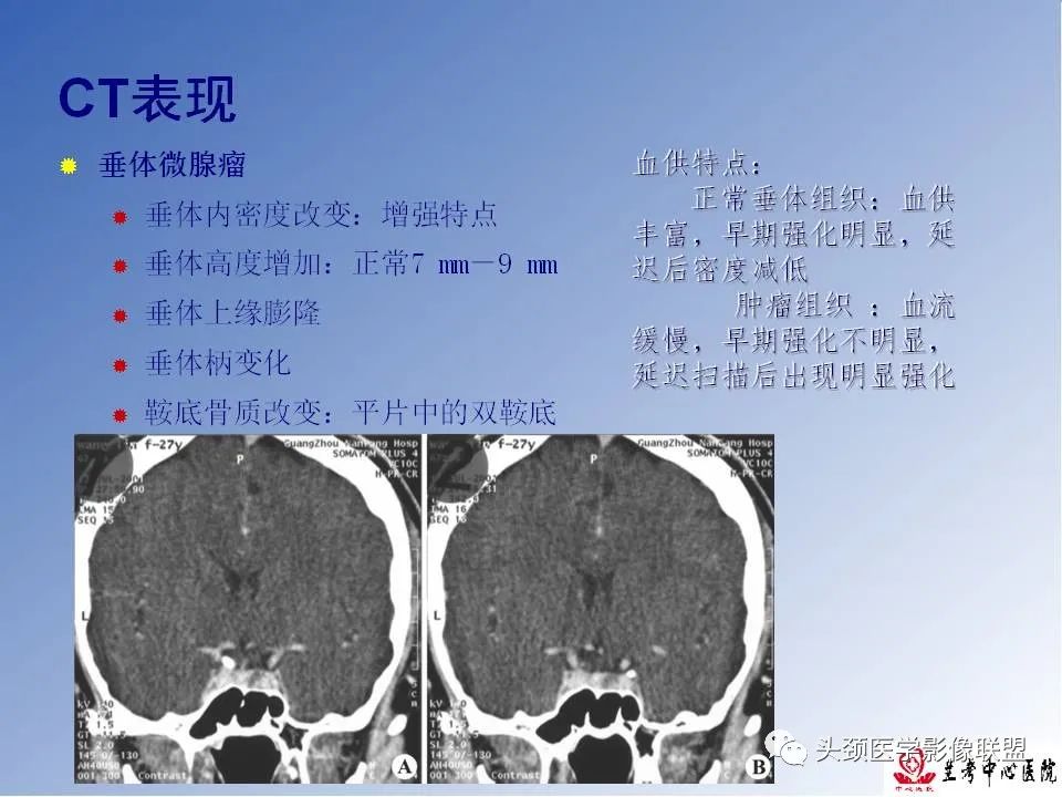 影像PPT - 【PPT】颅脑常见肿瘤影像诊断及鉴别-67