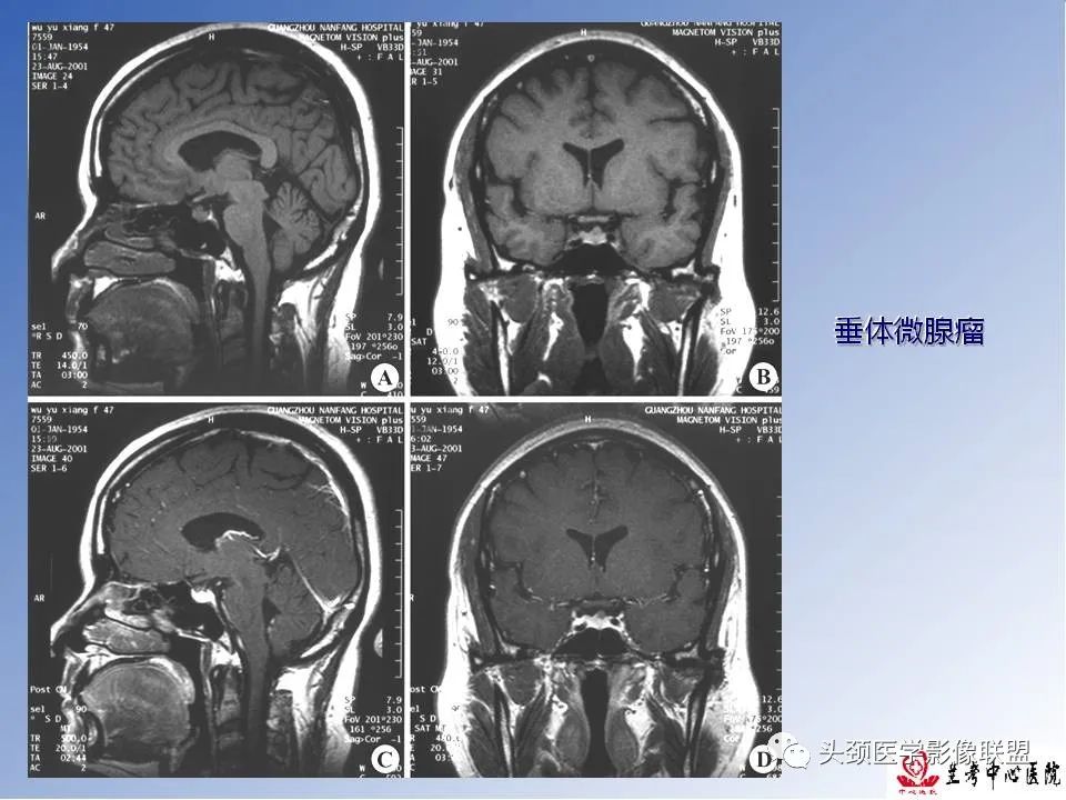 影像PPT - 【PPT】颅脑常见肿瘤影像诊断及鉴别-69
