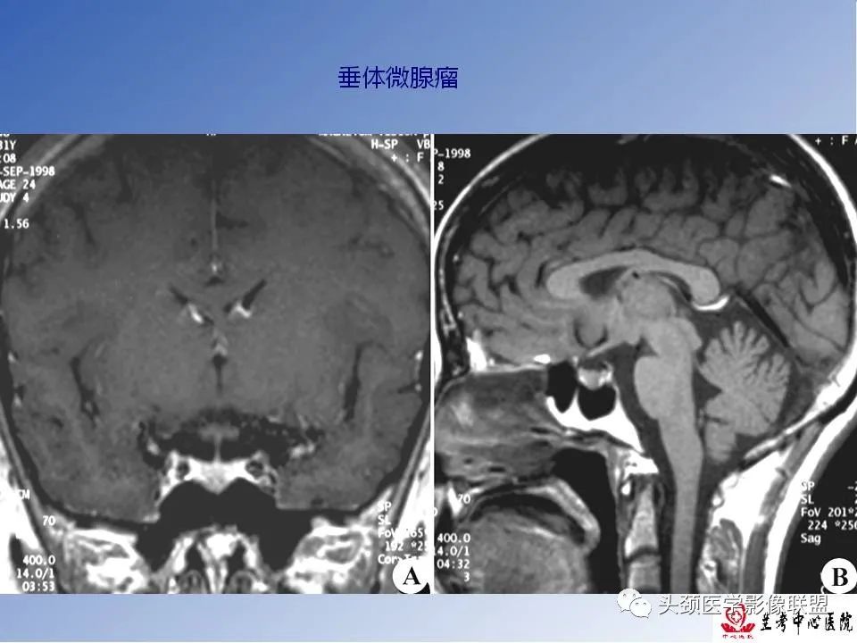 影像PPT - 【PPT】颅脑常见肿瘤影像诊断及鉴别-70
