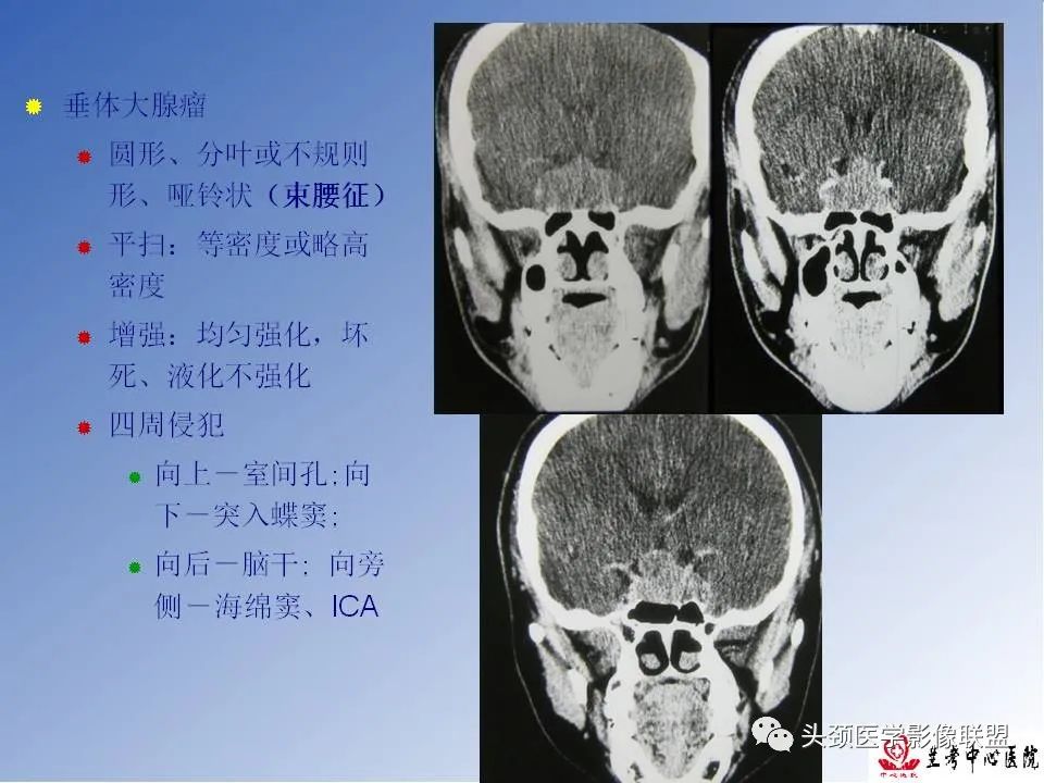 影像PPT - 【PPT】颅脑常见肿瘤影像诊断及鉴别-71