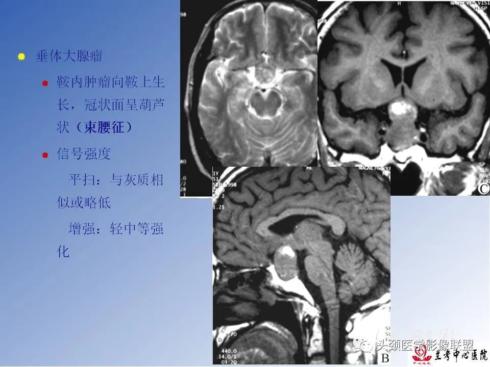 影像PPT - 【PPT】颅脑常见肿瘤影像诊断及鉴别-72