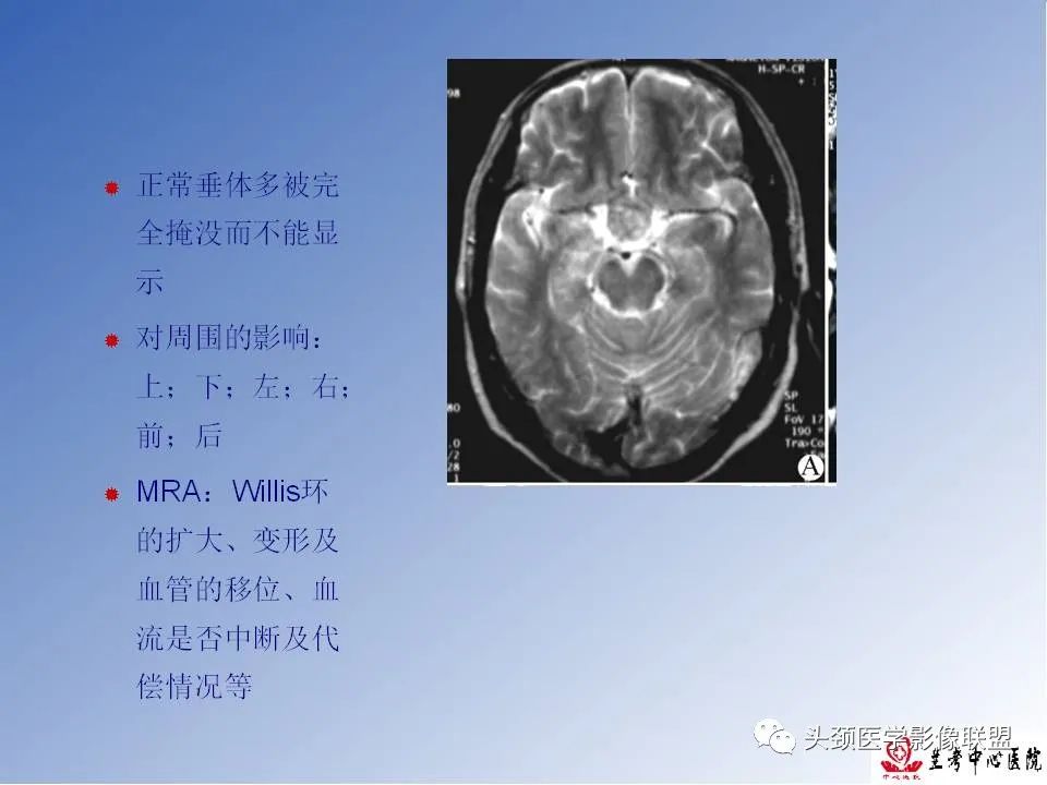 影像PPT - 【PPT】颅脑常见肿瘤影像诊断及鉴别-73