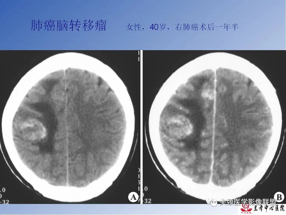 影像PPT - 【PPT】颅脑常见肿瘤影像诊断及鉴别-79