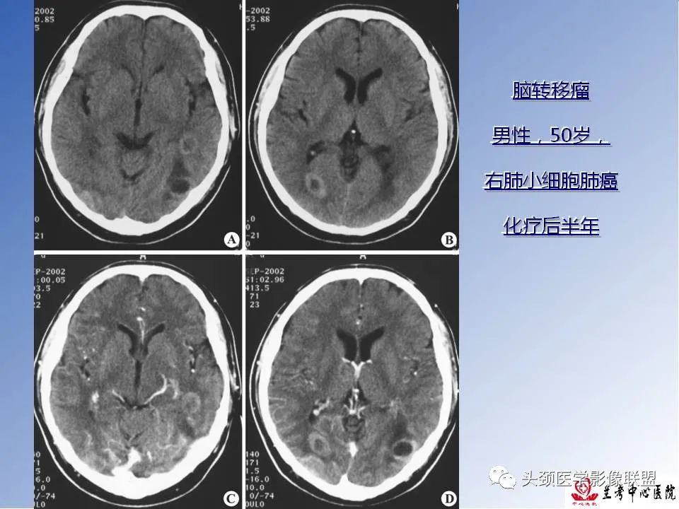 影像PPT - 【PPT】颅脑常见肿瘤影像诊断及鉴别-80