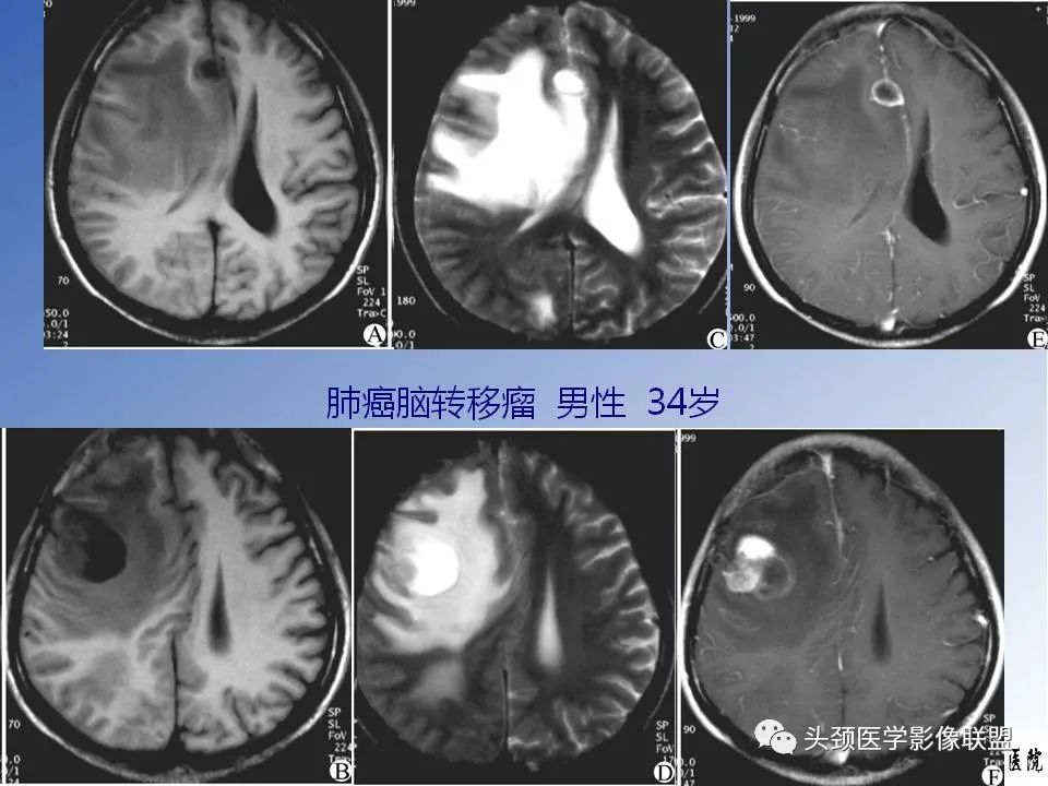 影像PPT - 【PPT】颅脑常见肿瘤影像诊断及鉴别-82