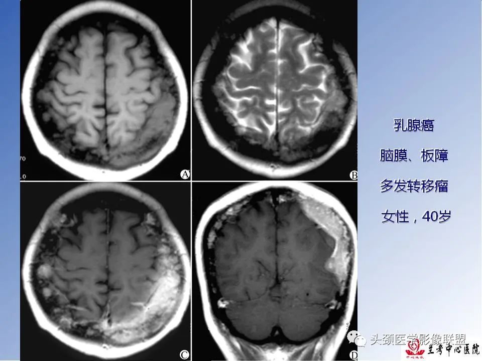 影像PPT - 【PPT】颅脑常见肿瘤影像诊断及鉴别-83