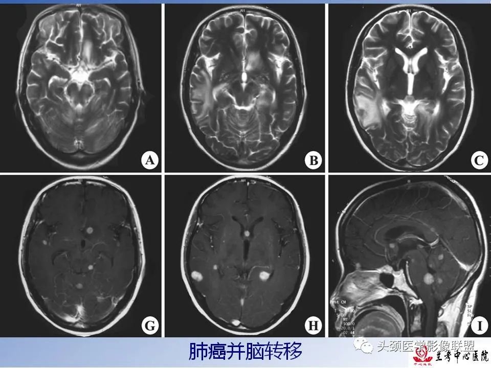 影像PPT - 【PPT】颅脑常见肿瘤影像诊断及鉴别-84