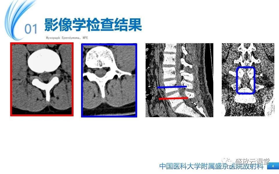 影像PPT - 【PPT】圆锥马尾型粘液乳头型室管膜瘤-4