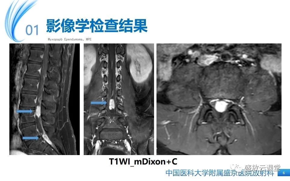 影像PPT - 【PPT】圆锥马尾型粘液乳头型室管膜瘤-6