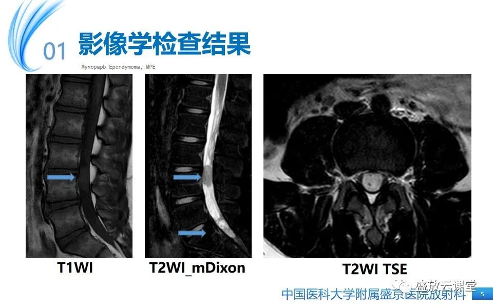 影像PPT - 【PPT】圆锥马尾型粘液乳头型室管膜瘤-5