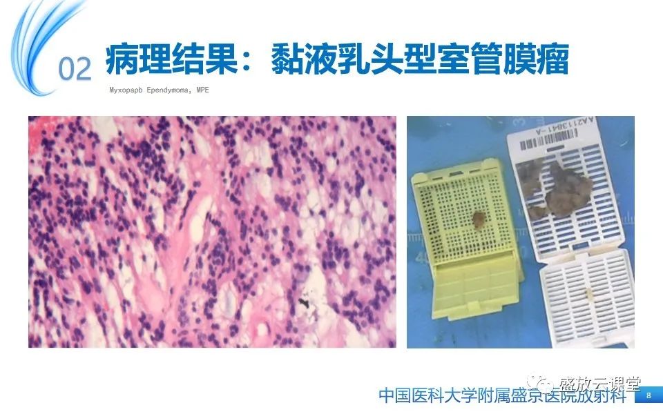 影像PPT - 【PPT】圆锥马尾型粘液乳头型室管膜瘤-8