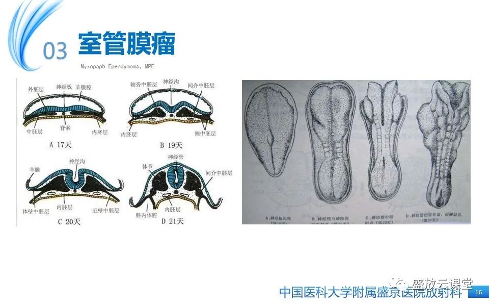 影像PPT - 【PPT】圆锥马尾型粘液乳头型室管膜瘤-16