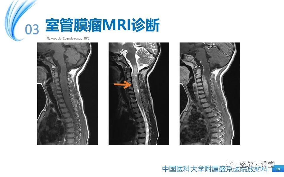 影像PPT - 【PPT】圆锥马尾型粘液乳头型室管膜瘤-18