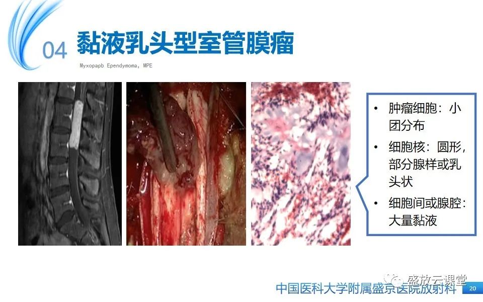 影像PPT - 【PPT】圆锥马尾型粘液乳头型室管膜瘤-20