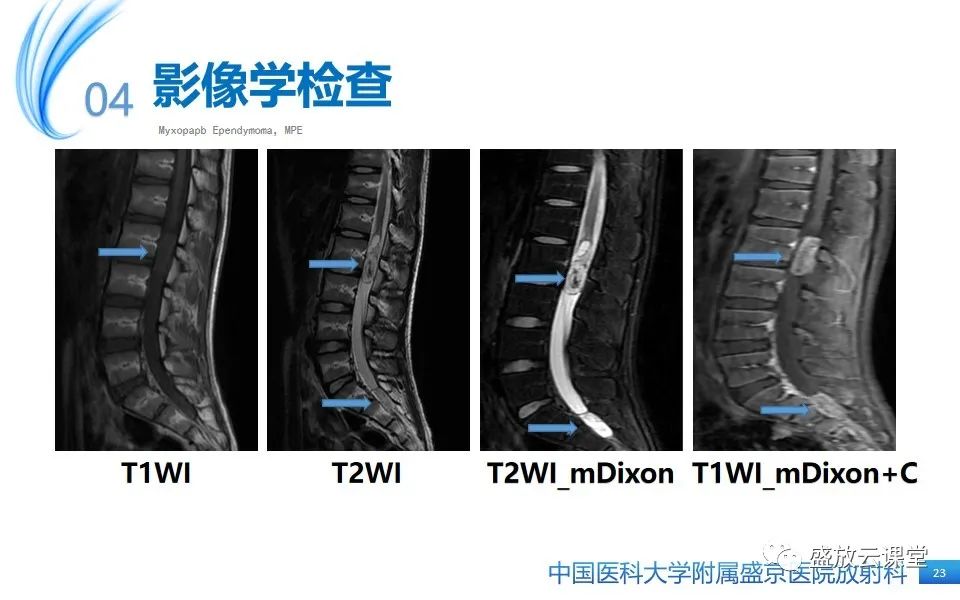 影像PPT - 【PPT】圆锥马尾型粘液乳头型室管膜瘤-23