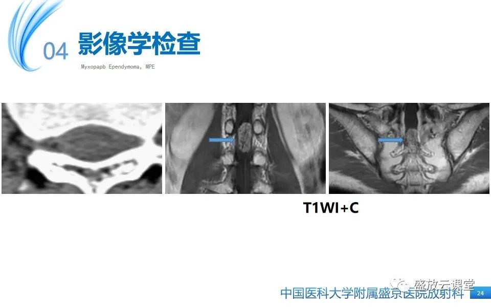 影像PPT - 【PPT】圆锥马尾型粘液乳头型室管膜瘤-24