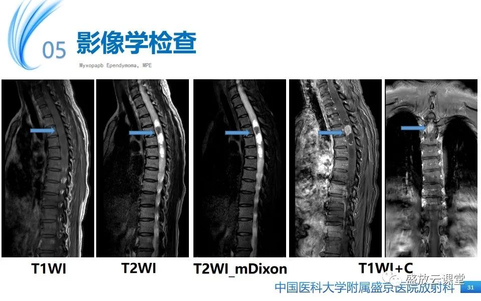 影像PPT - 【PPT】圆锥马尾型粘液乳头型室管膜瘤-31