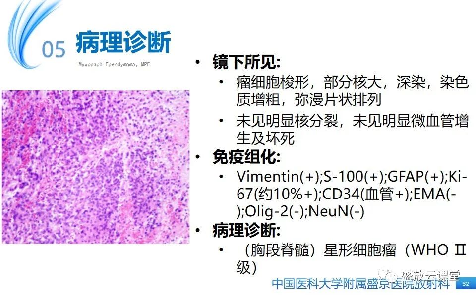 影像PPT - 【PPT】圆锥马尾型粘液乳头型室管膜瘤-32