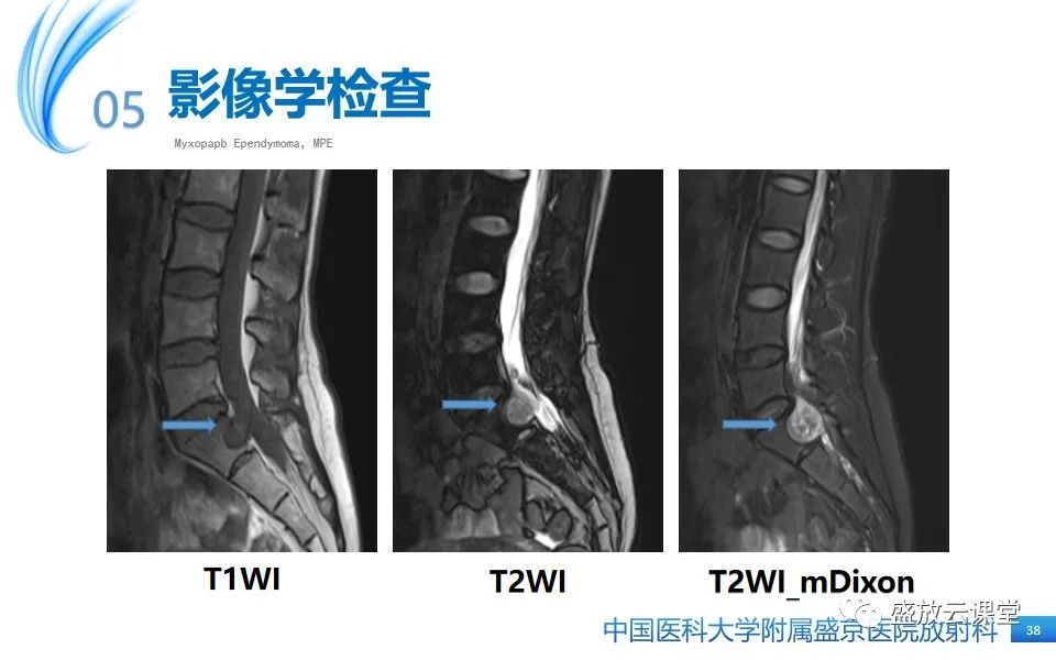 影像PPT - 【PPT】圆锥马尾型粘液乳头型室管膜瘤-38